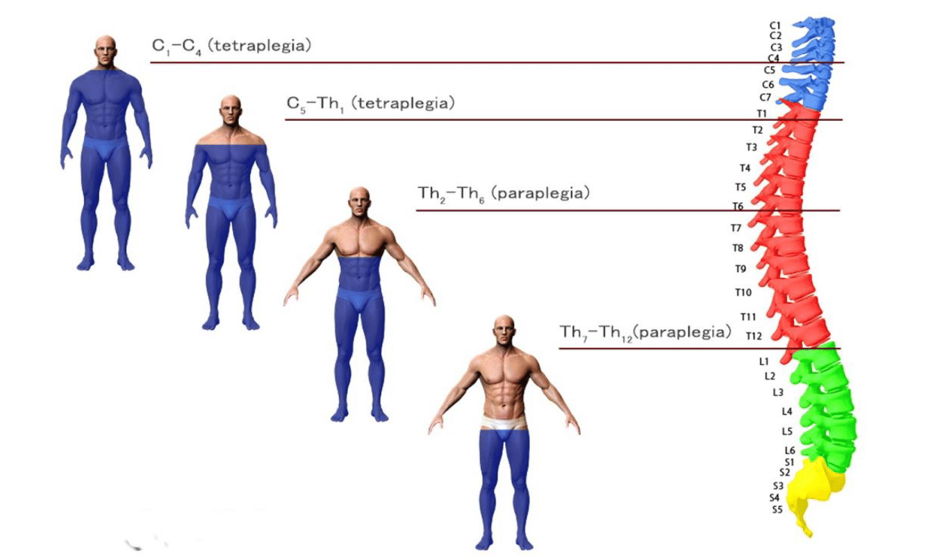 Appunti OSS, rappresentazione del livello di compromissione motoria del paziente, in relazione alla posizione della lesione del midollo spinale ungo la colonna vertebrale. In particolare, una lesione completa in area cervicale C1-C4 comporta la tetraplegi