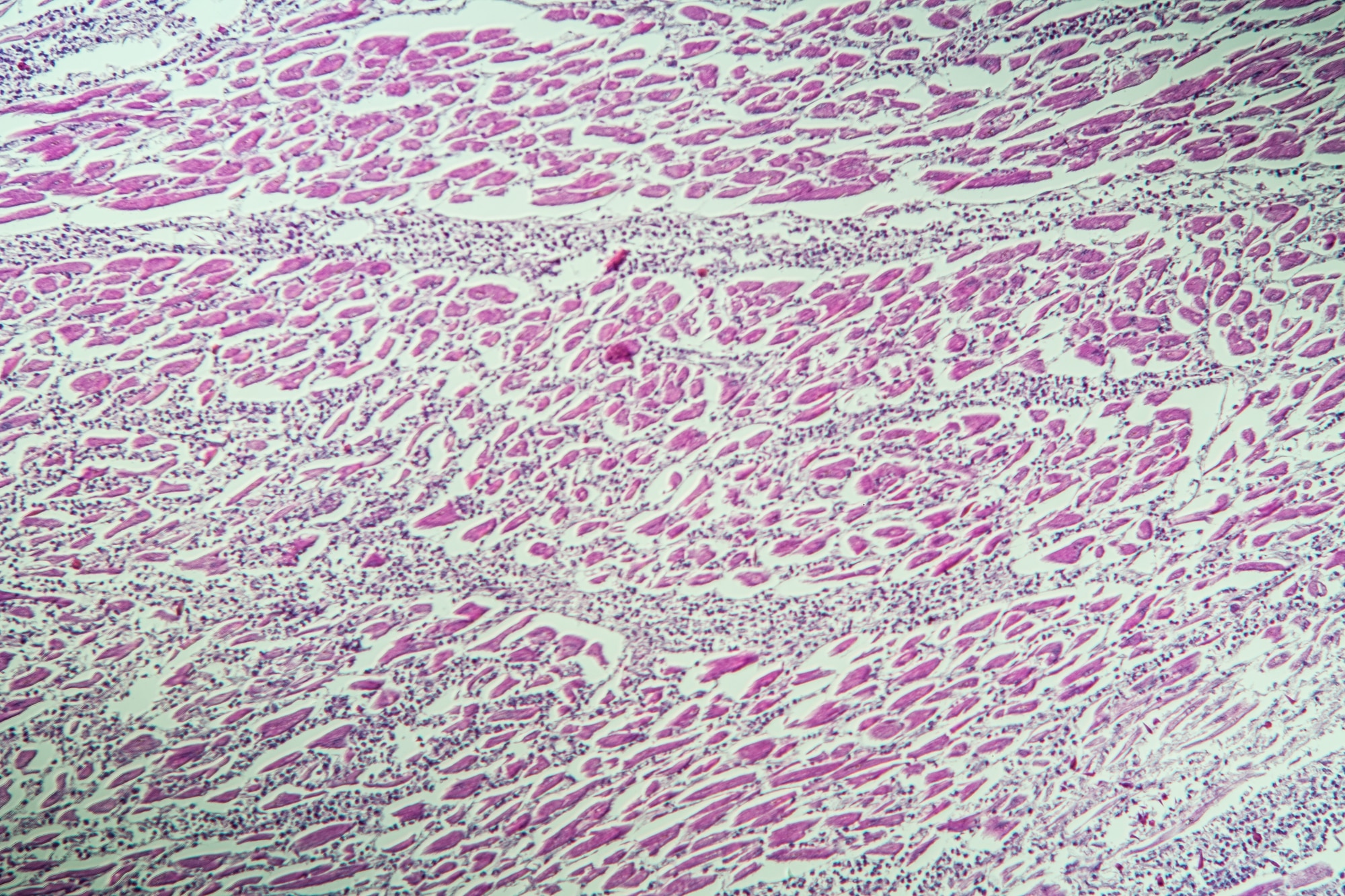 Tessuto muscolare cardiaco infiammato