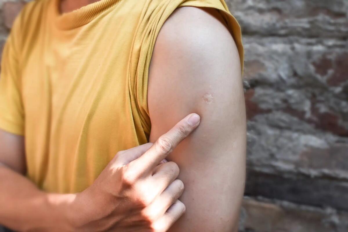 Perché alcune persone hanno una cicatrice dopo la vaccinazione del BCG? - 