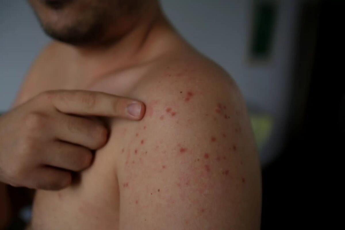 I casi di morbillo in Italia sono in aumento: calo delle vaccinazioni - 