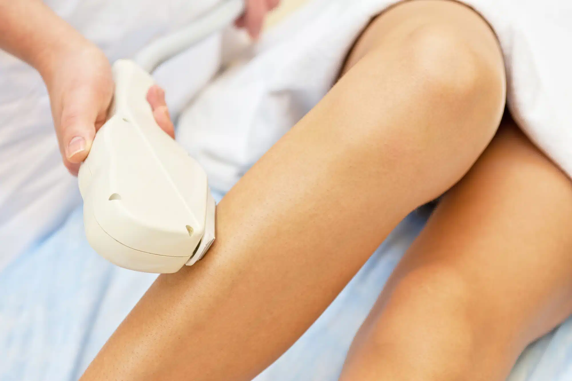 Trattamento laser per i capillari: come funziona e quali sono i benefici