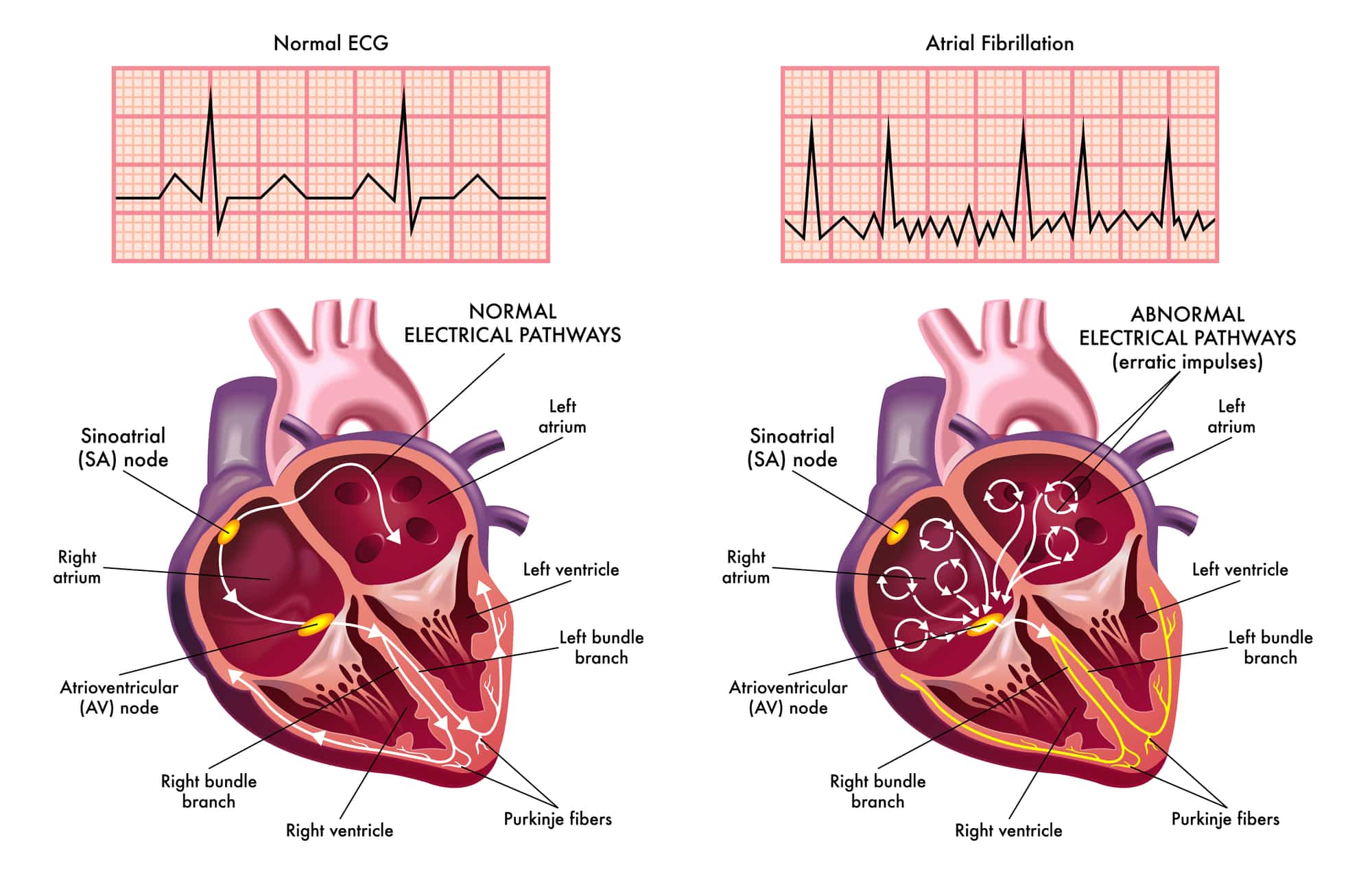 In figura l'ECG di un paziente con fibrillazione atriale al confronto con l'ECG di un paziente sano.
