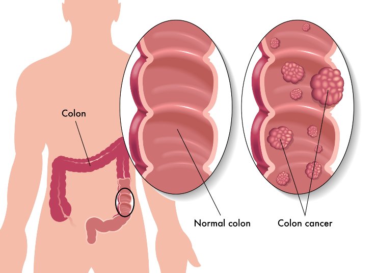 Schema del tumore al colon (Depositphotos foto) - www.biomedicalcue.it