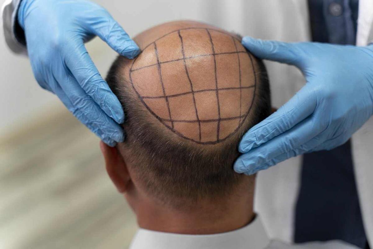 Il miglior trapianto di capelli: guida completa per scegliere la soluzione ideale - 