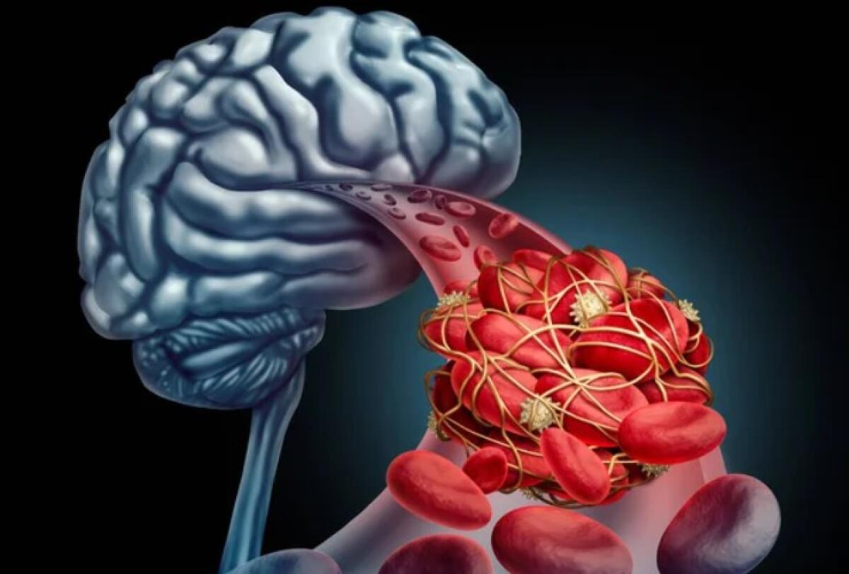 Ictus e infarto, l'inverno miete sempre più vittime: ecco il fattore in questa stagione - Illustrazione di un ictus (Depositphotos FOTO) - www.biomedicalcue.it