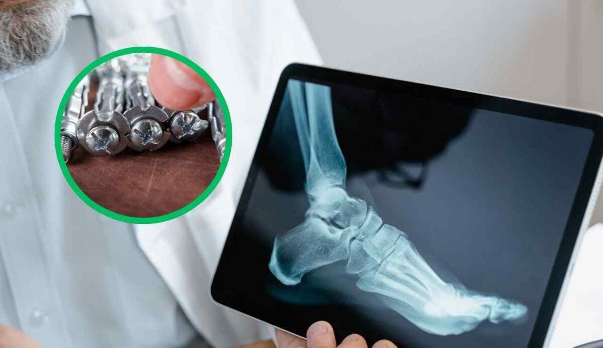Ortopedia, una nuova lega di zinco promette impianti più sicuri e senza interventi di rimozione - Zinco ortopedico come funziona (Canva Foto) - www.biomedicalcue.it