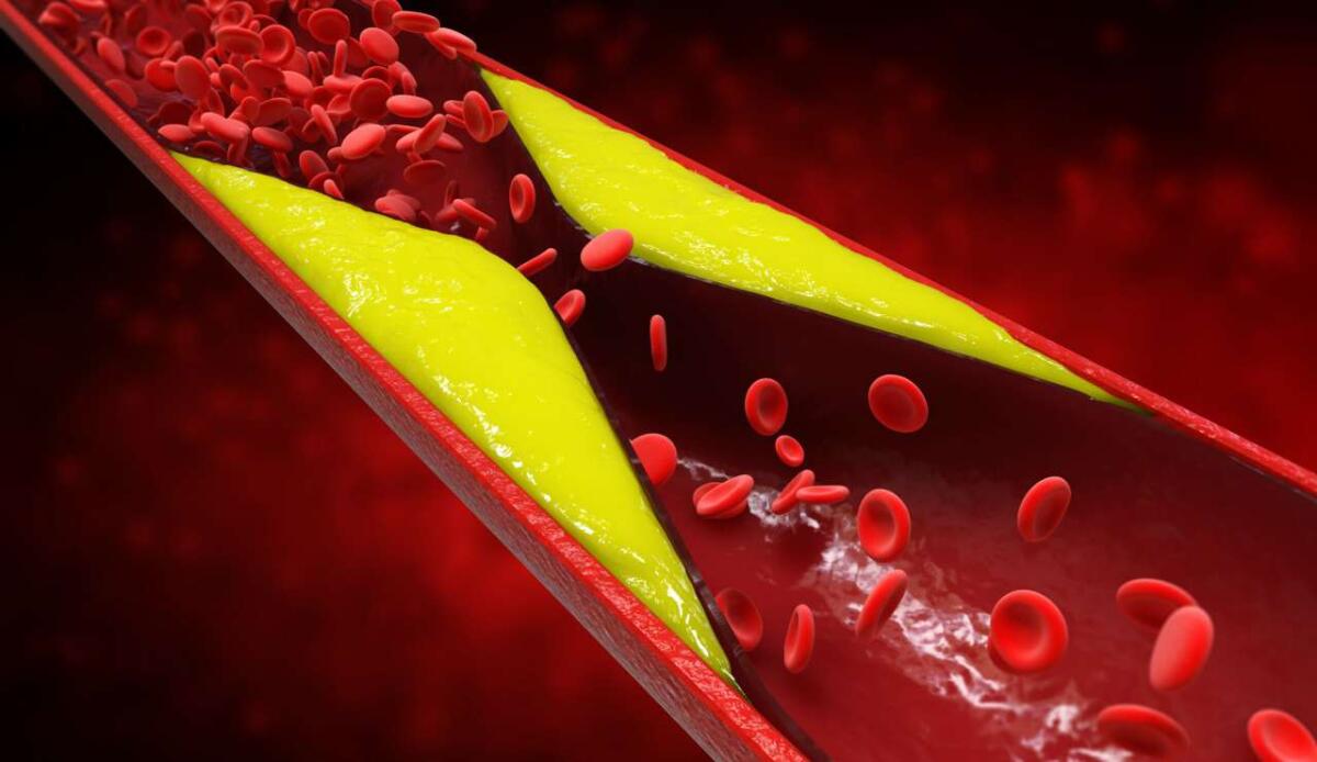Scoperta la struttura del colesterolo LDL, un passo avanti nella prevenzione delle malattie cardiache - Illustrazione del colesterolo nel sangue (Depositphotos foto) - www.biomedicalcue.it