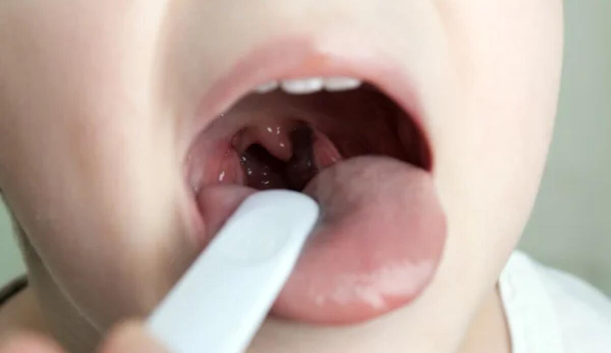 Rimosse da bambini, ricresciute da adulti: le tonsille tornano nel 6% dei casi - L'inattesa ricrescita delle tonsille (Depositphotos foto) - www.biomedicalcue.it