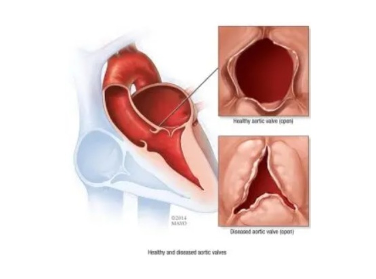 Valvola aortica (Mayo Clinic foto) - www.biomedicalcue.it