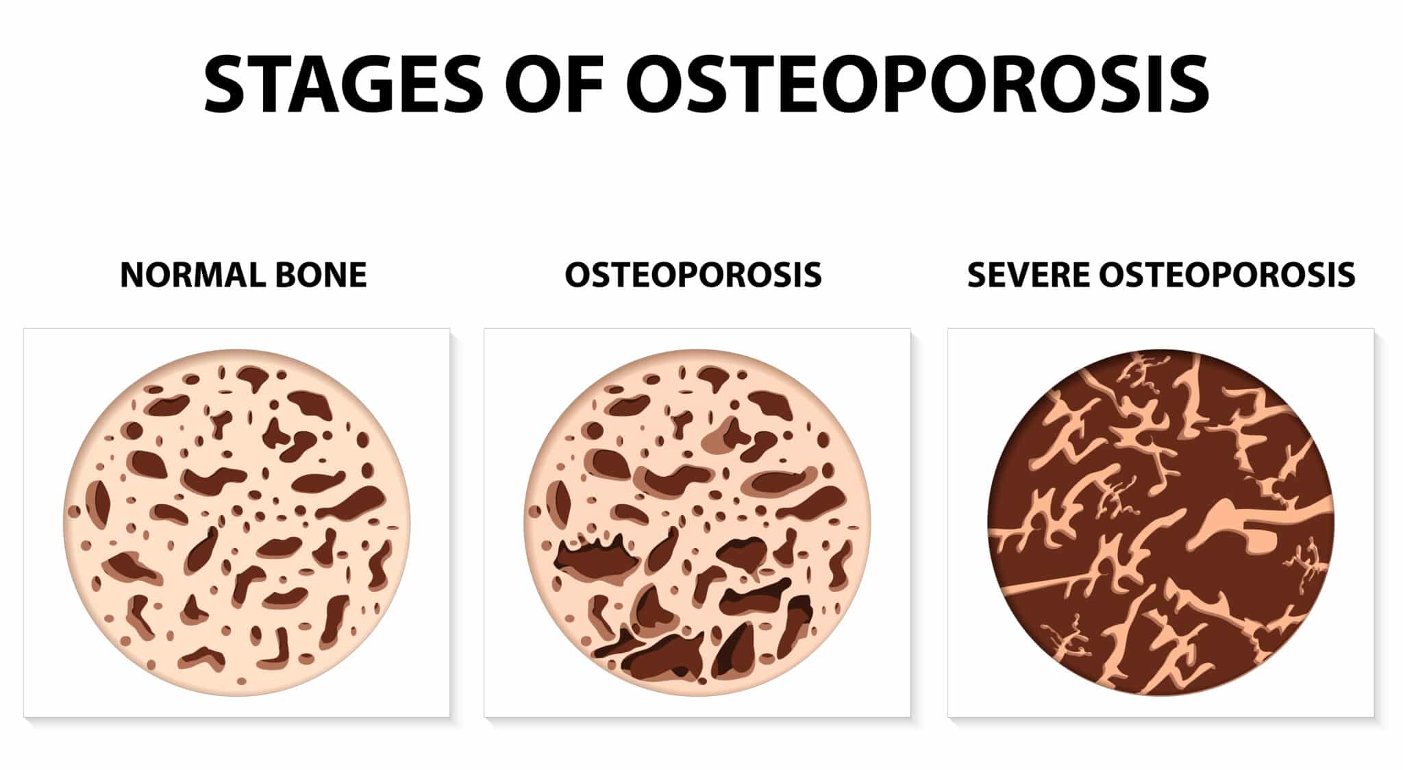 Diversi livelli di osteoporosi
