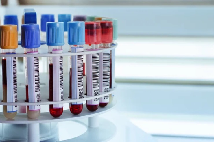 Provette di sangue (Depositphotos foto) - www.biomedicalcue.it