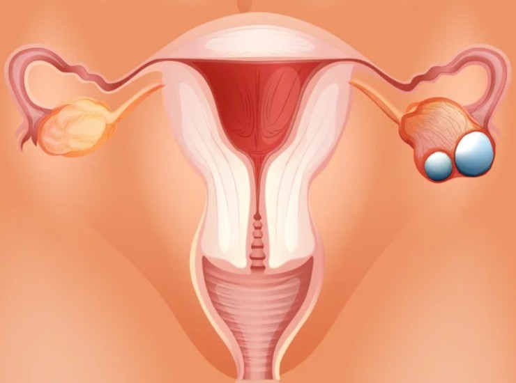 Illustrazione di un cancro ovarico (Depositphotos foto) - www.biomedicalcue.it