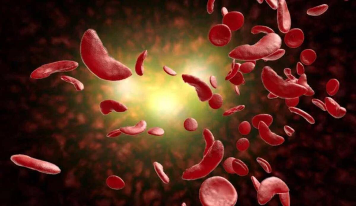 Anemia falciforme: il trapianto di midollo potrebbe sostituire la terapia genica - Anemia falciforme (Depositphotos foto) - www.biomedicalcue.it