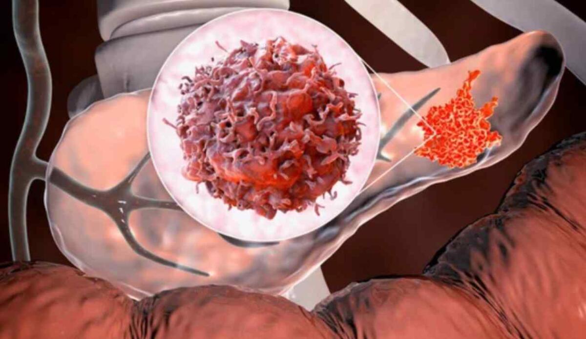 Tumore al pancreas: cos'è, sintomi e cause della malattia di Eleonora Giorgi - Tumore al pancreas (Depositphotos foto) - www.biomedicalcue.it