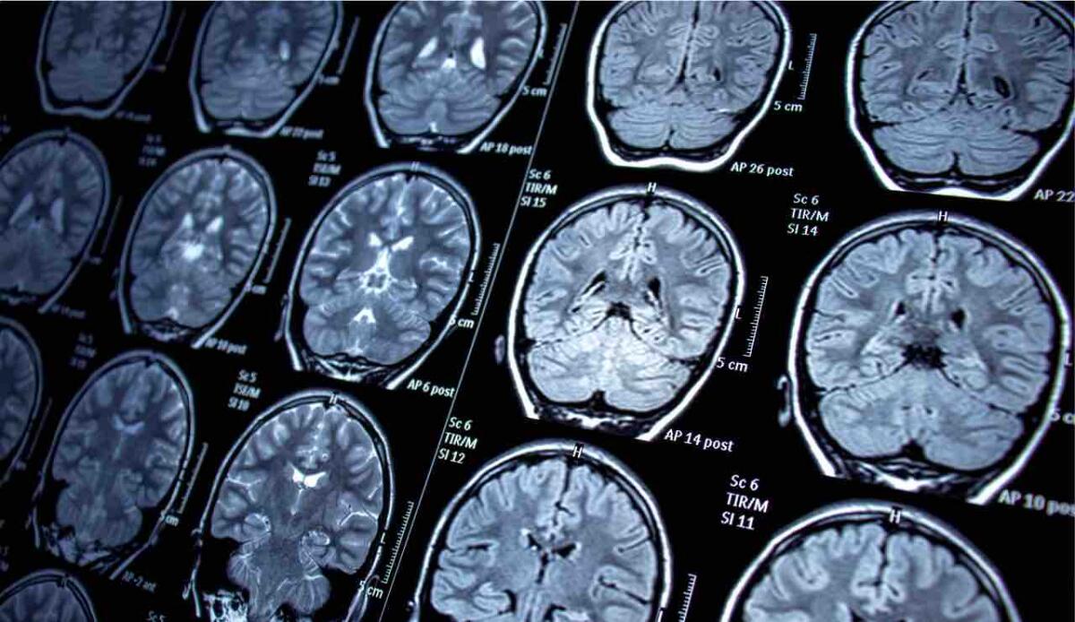 Epilessia infantile: l'AI scopre lesioni cerebrali invisibili all'occhio umano - Come intercettare l'epilessia (Canva) - systemscue.it