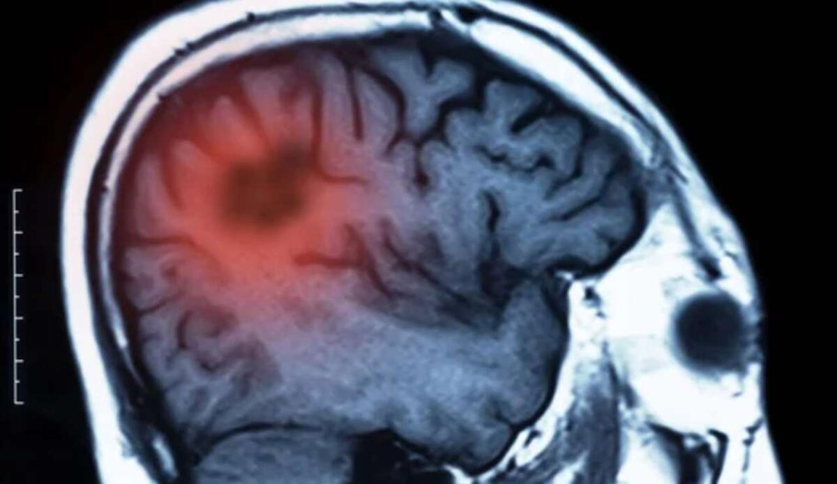 Tumori cerebrali: scoperto il meccanismo che trasforma il sistema immunitario in un alleato del cancro - Tumore cerebrale (Depositphotos foto) - www.biomedicalcue.it