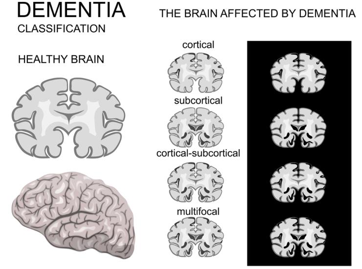 Schema demenza