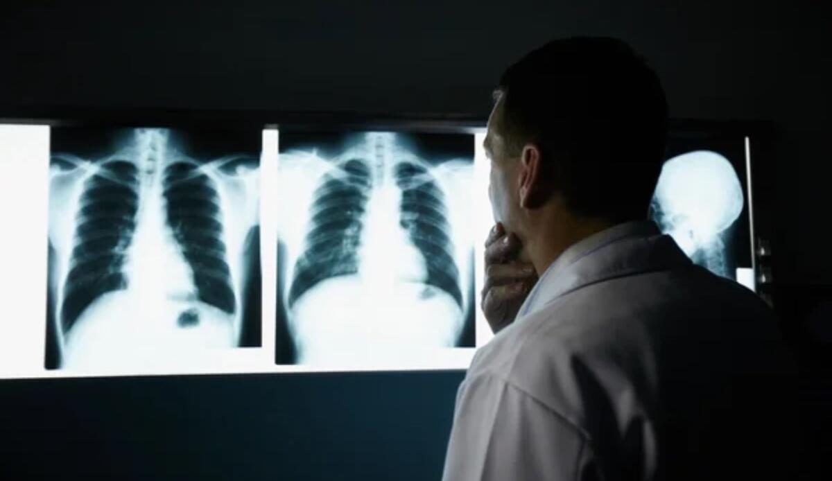 Il ruolo della dieta nella prevenzione del cancro ai polmoni: la sorprendente connessione con il glicogeno - Valutazione cancro polmonare (Depositphotos foto) - www.biomedicalcue.it