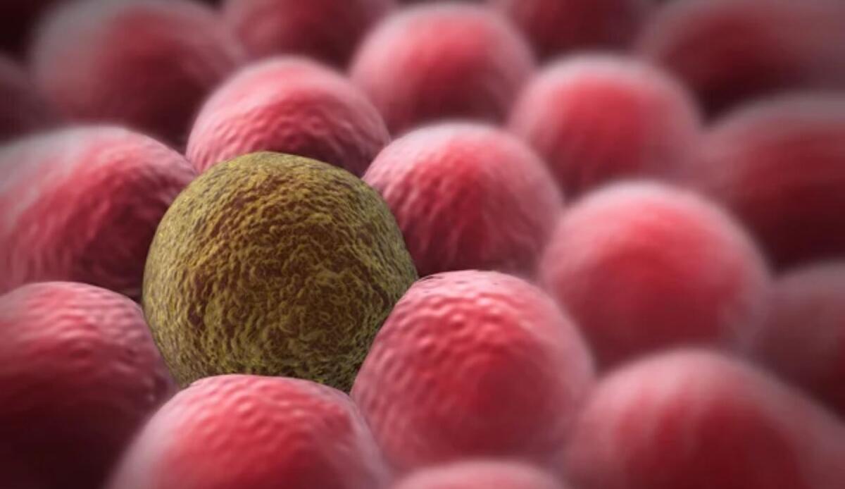 Terapia di precisione contro il cancro: riattivato l'interruttore molecolare che blocca la crescita tumorale - Cellula tumorale (Depositphotos foto) - www.biomedicalcue.it