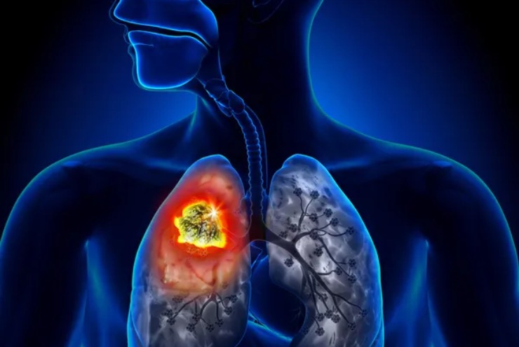 Cancro ai polmoni (Depositphotos foto) - www.biomedicalcue.it