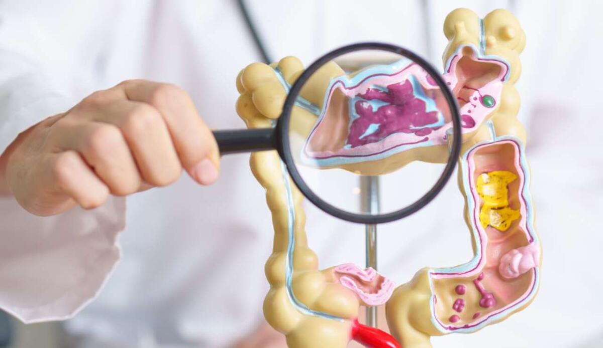 Cancro al colon resistente: nuova terapia attiva le cellule T e riaccende la risposta immunitaria - Illustrazione di un tumore al colon (Canva FOTO) - biomedicalcue.it