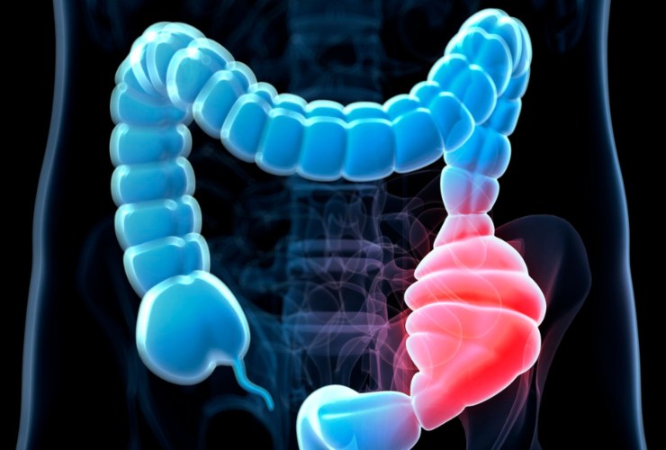 Illustrazione di un tumore al colon (Canva FOTO) -biomedicalcue.it