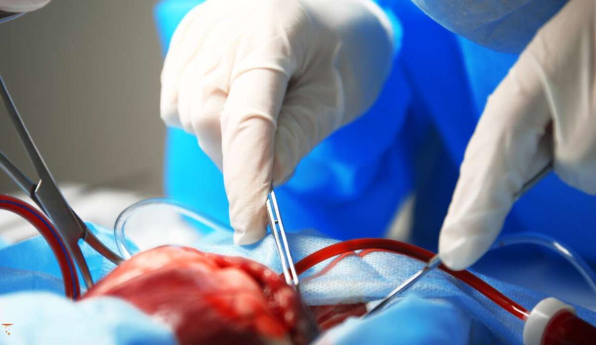 Sicilia, primo trapianto di cuore da donatore a cuore fermo: intervento storico a Palermo - Illustrazione di un'operazione (Canva FOTO) - biomedicalcue.it