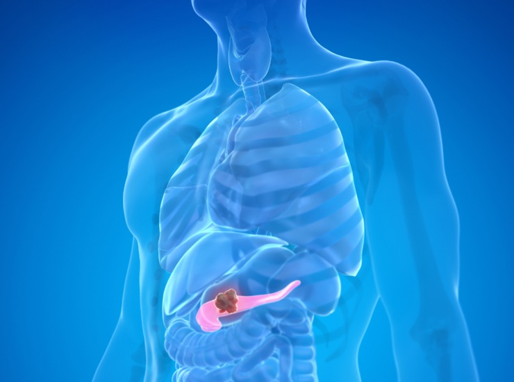 Illustrazione del tumore al pancreas (Canva FOTO) - biomedicalcue.it