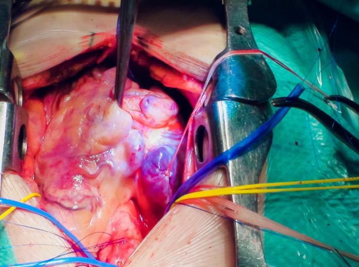 Illustrazione di un trapianto (Canva FOTO) - biomedicalcue.it