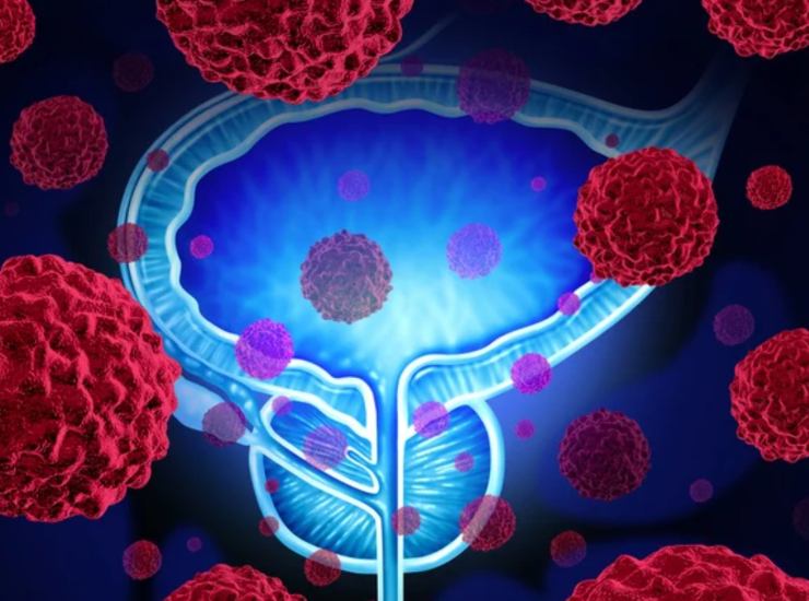 Illustrazione di cancro alla prostata (Depositphotos foto) - www.biomedicalcue.it