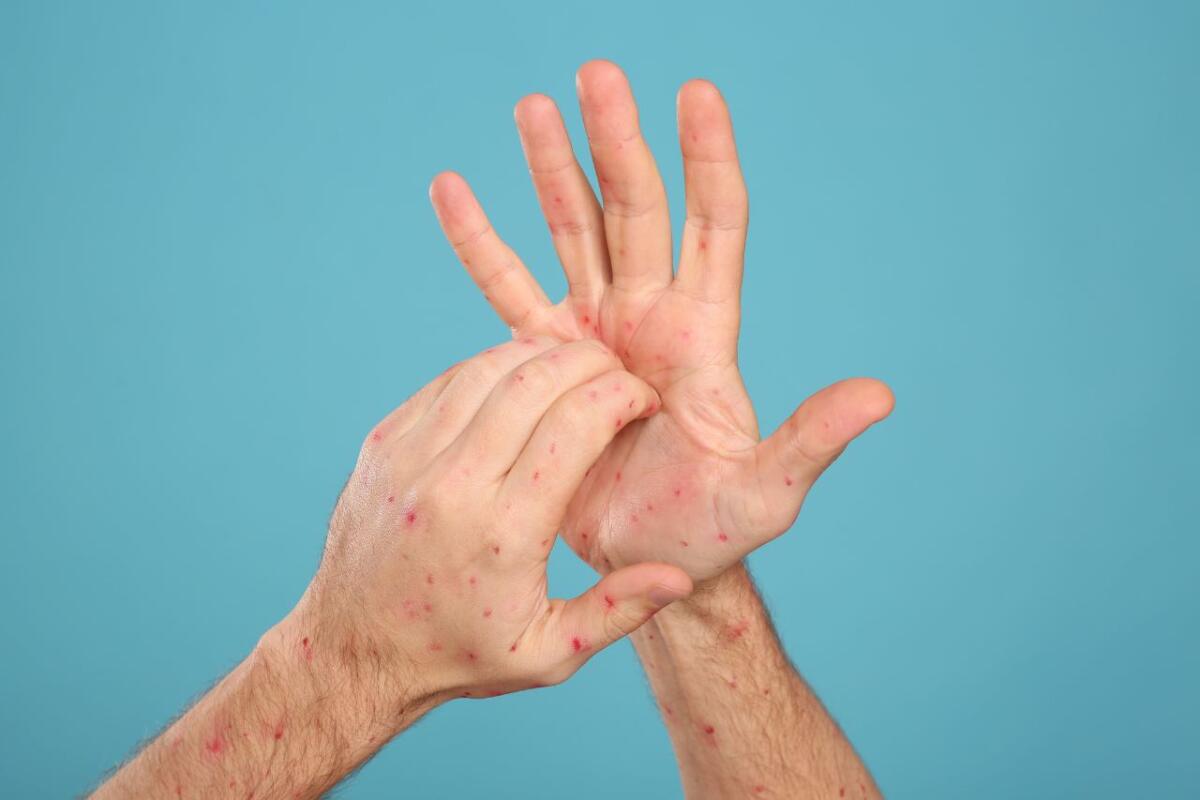 Scoperta una nuova vulnerabilità nel virus del vaiolo delle scimmie grazie all'intelligenza artificiale - Man with rash suffering from monkeypox virus on light blue background, closeup