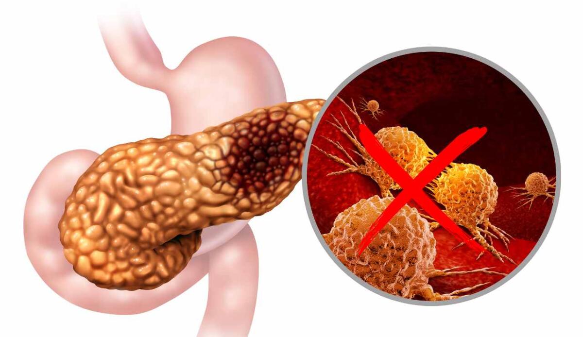 Pancreas: la tripla terapia che elimina i tumori nei topi e impedisce la resistenza - 