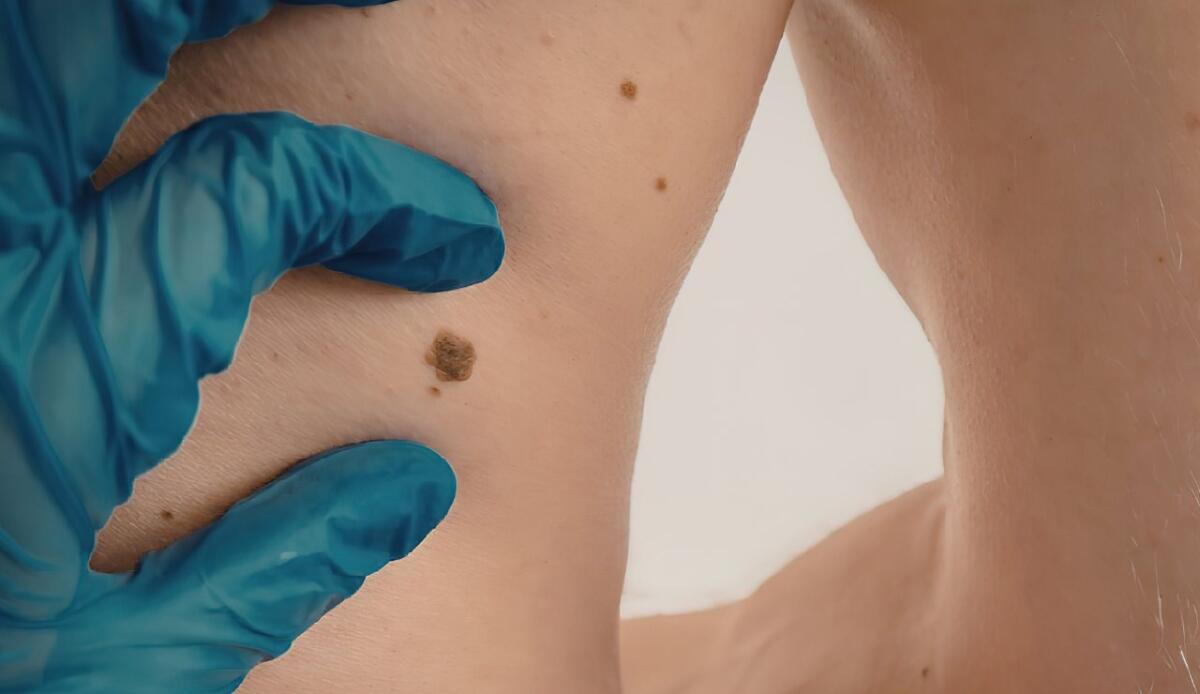 Vaccino a mRNA e melanoma: cosa dicono i dati a cinque anni dello studio KEYNOTE-942 - 