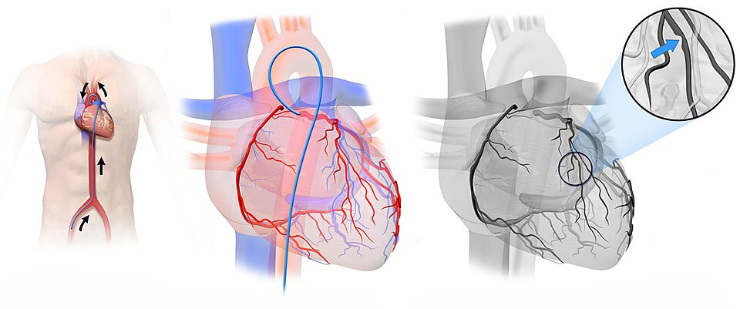 Coronarografia che mostra l'albero vascolare e l'anatomia delle arterie coronarie. (Fonte: BruceBlaus via Wikimedia Commons / CC BY-SA 4.0)