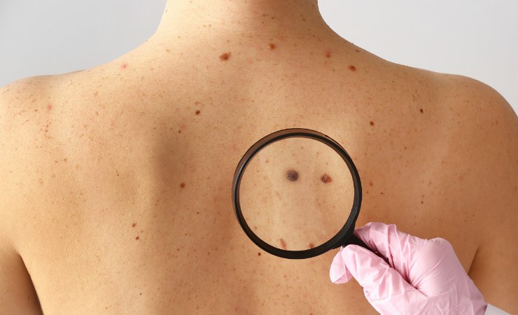 Vaccino a mRNA e melanoma: cosa dicono i dati a cinque anni dello studio KEYNOTE-942