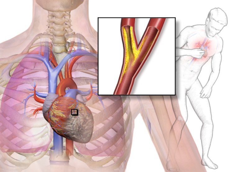 Rappresentazione clinica dell'angina pectoris con focus sulla placca aterosclerotica nell'arteria coronaria. (Fonte: BruceBlaus via Wikimedia Commons / CC BY 3.0)