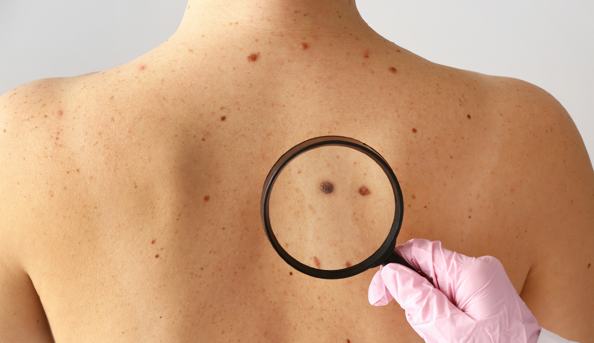 Rapporto tra sole e melanoma