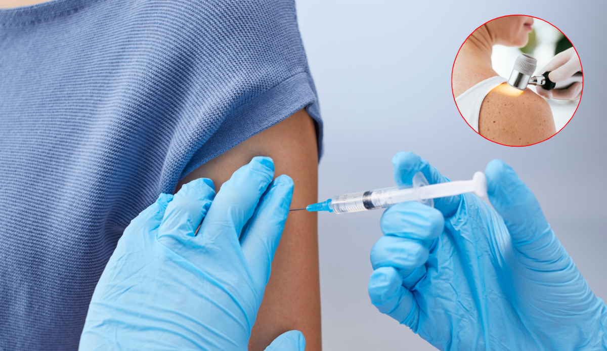 Vaccino a mRNA contro il melanoma? Cosa dicono davvero i risultati di fase 3