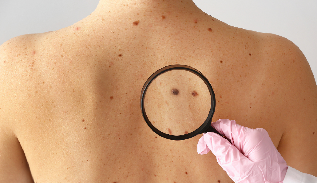 Melanoma