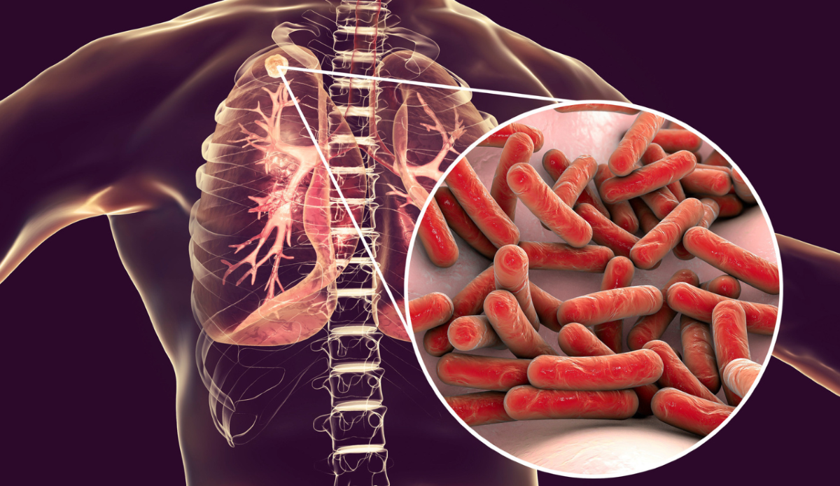 Otto casi di tubercolosi all'Istituto di Medicina legale di Milano
